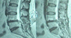 Notice the decrease in the hight of the disc space!