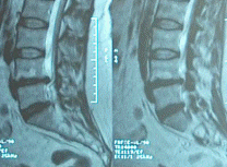 Notice the hight of the disc space before the first operation!