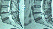 The intradutal part of the recurrence